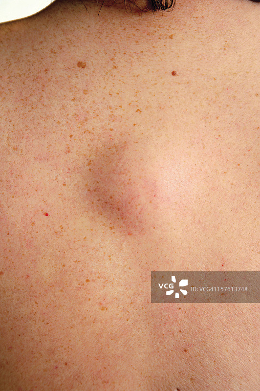 脂肪瘤图片素材