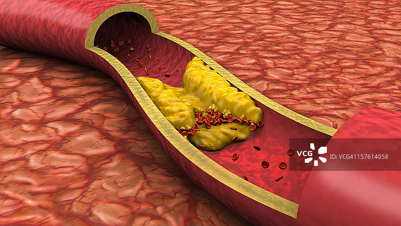 堵塞的动脉低角度视图（3D）图片素材