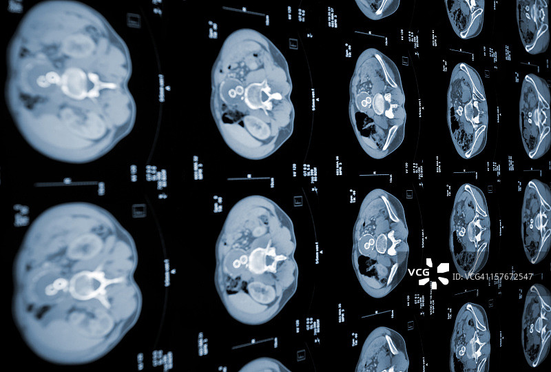 人体腹部的CT扫描图片素材