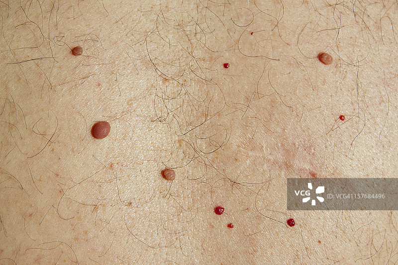 皮肤问题：痣、血管瘤、囊肿和手术疤痕图片素材