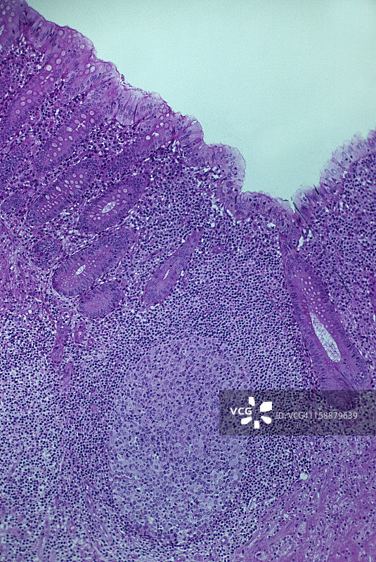 人类带有淋巴结的阑尾，100倍图片素材