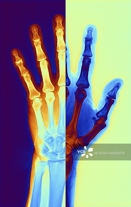 关节炎手部X光片图片素材