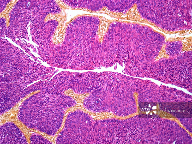 膀胱癌显微照片图片素材