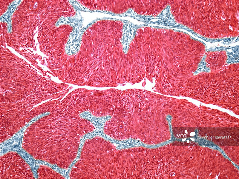 膀胱癌显微照片图片素材