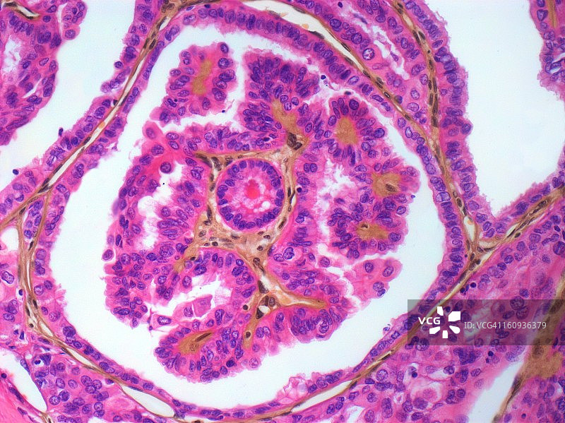 甲状腺癌，光学显微照片图片素材