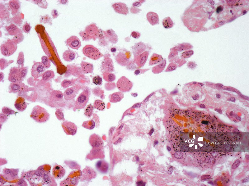 肺组织中的石棉，光学显微照片图片素材