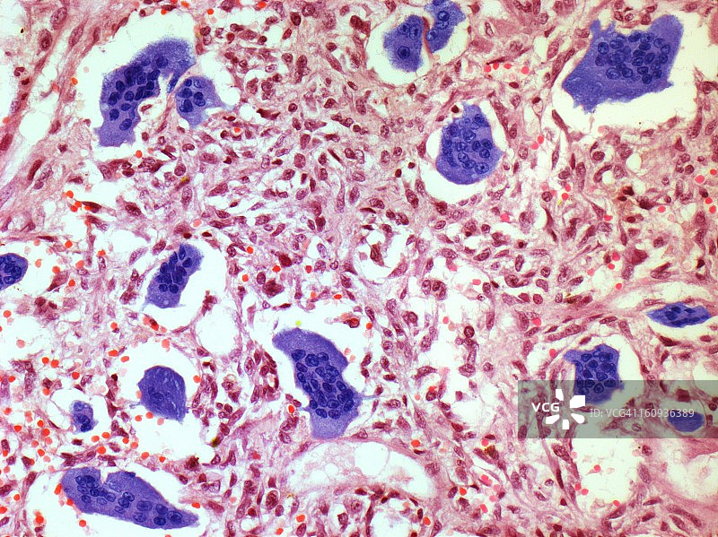骨肿瘤显微照片图片素材