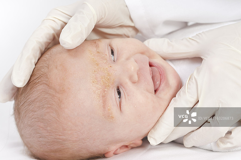医生检查患有脂溢性皮炎的婴儿图片素材