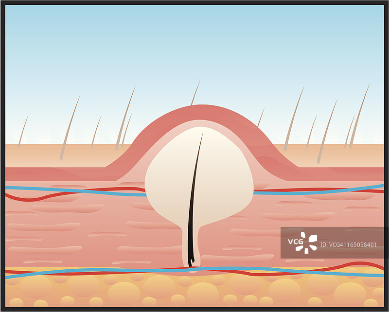 皮下毛发生长示意图图片素材