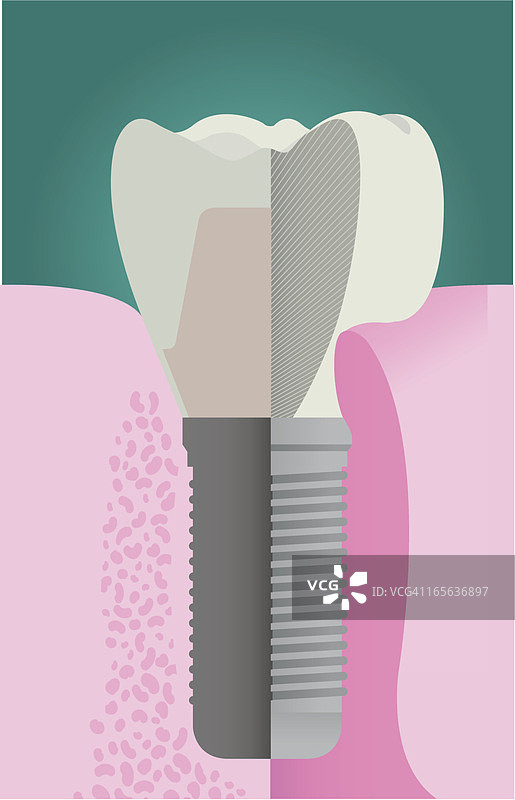 植入体剖面图图片素材