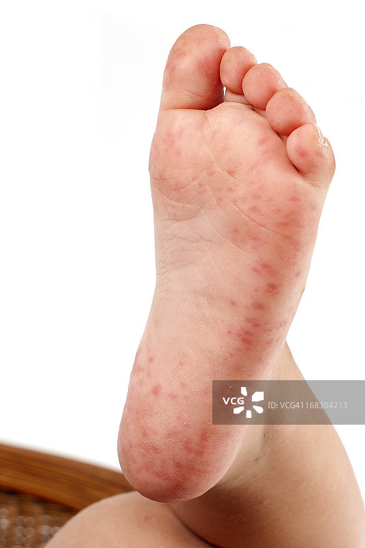 儿童足部毛囊炎图片素材