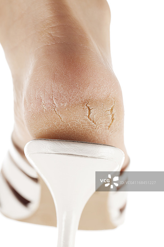 白色背景：鞋内干燥开裂的脚底图片素材