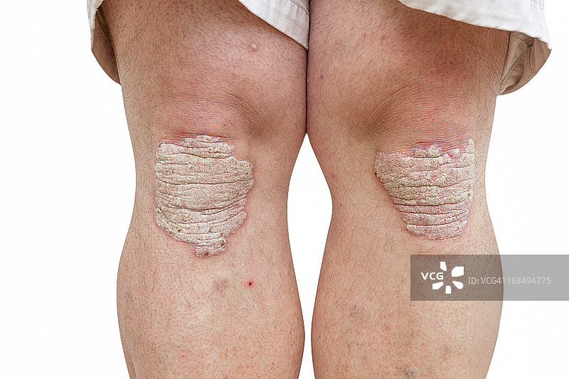 中年男子膝盖上的银屑病图片素材