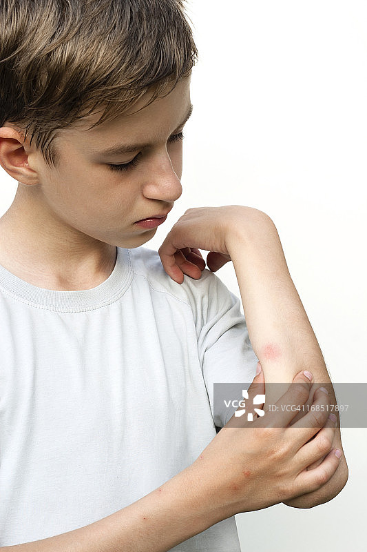 男孩看着蚊虫叮咬处图片素材