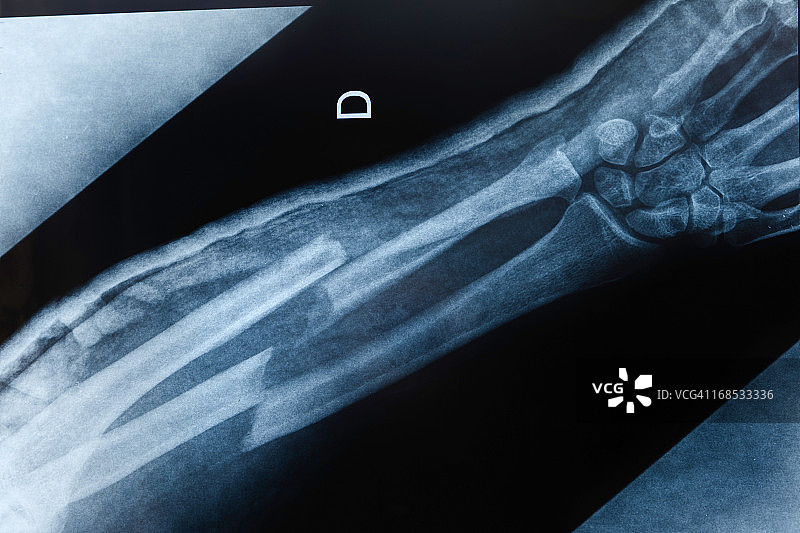 手臂骨折X光片图片素材