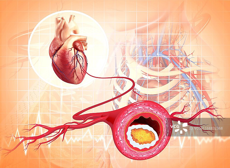 动脉粥样硬化医学插图图片素材