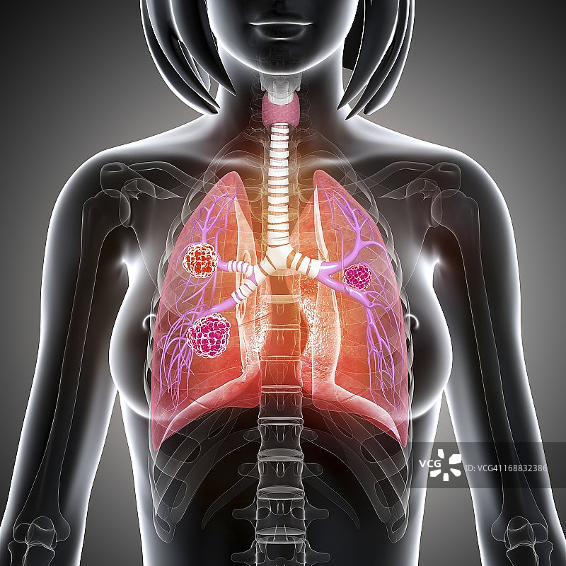 女性肺癌艺术作品图片素材