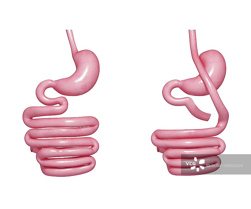 胃旁路手术图片素材