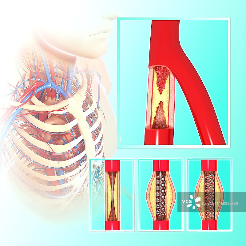血管成形术（艺术作品）图片素材