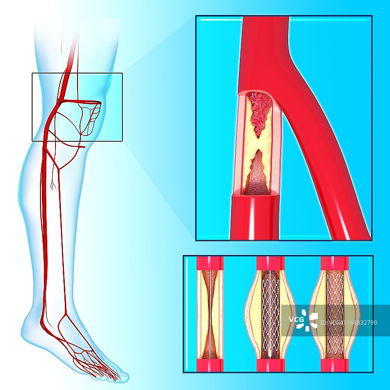 血管成形术（艺术作品）图片素材