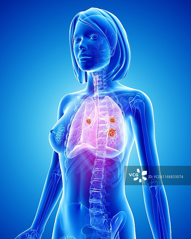 女性肺癌艺术作品图片素材