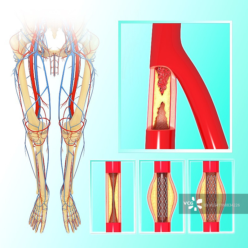 血管成形术（艺术作品）图片素材