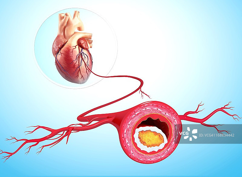 动脉粥样硬化医学插图图片素材