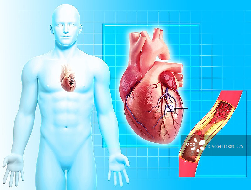动脉粥样硬化医学插图图片素材