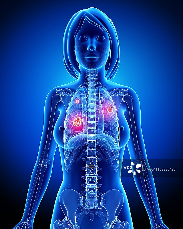 女性肺癌艺术作品图片素材