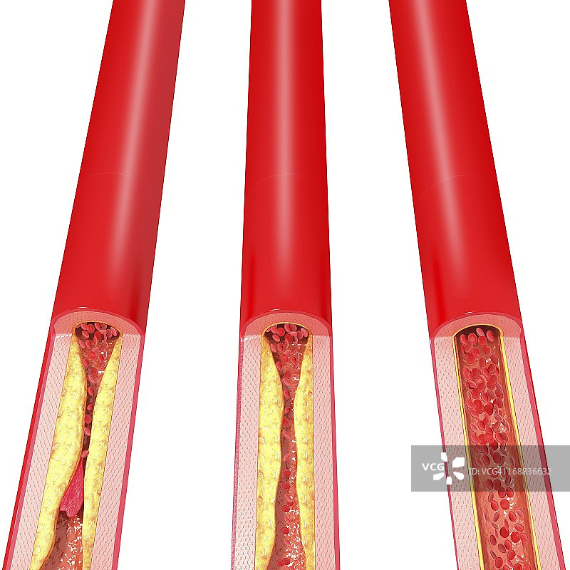 动脉粥样硬化医学插图图片素材