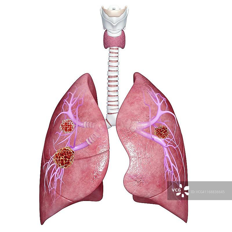 肺癌艺术作品图片素材