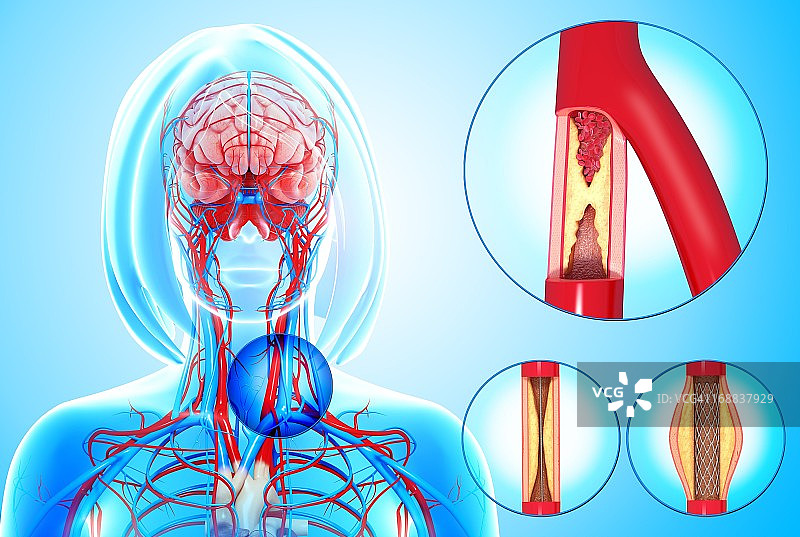 动脉粥样硬化医学插图图片素材