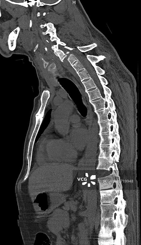 强直性脊柱炎图片素材