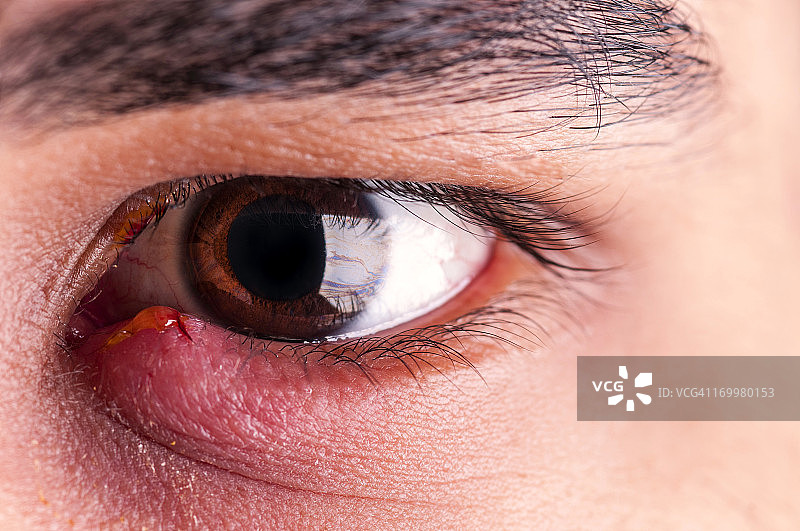 麦粒肿-眼部感染图片素材