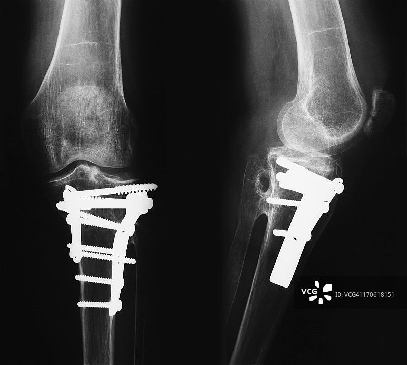 含骨合成材料的断腿X光影像图片素材