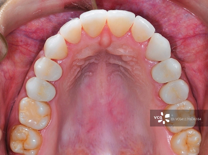 全瓷牙冠图片素材