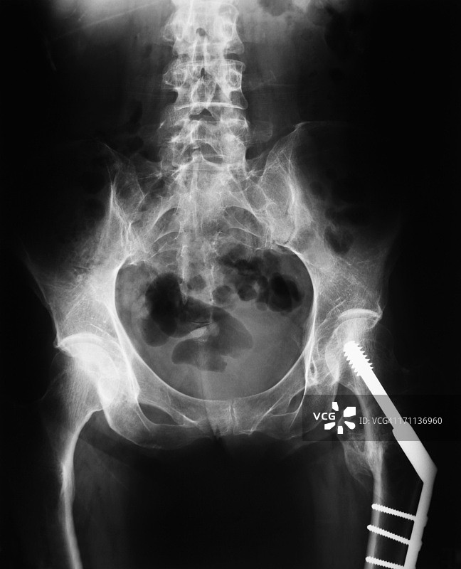 髋部骨折治疗的X光影像图片素材
