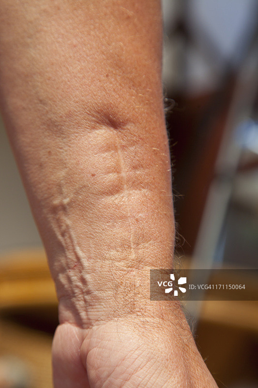 有疤痕的手腕图片素材