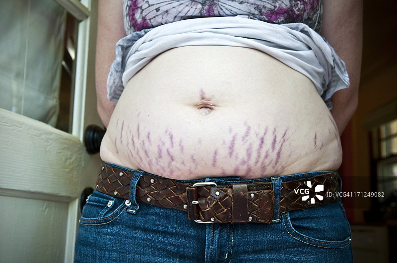妊娠纹图片素材