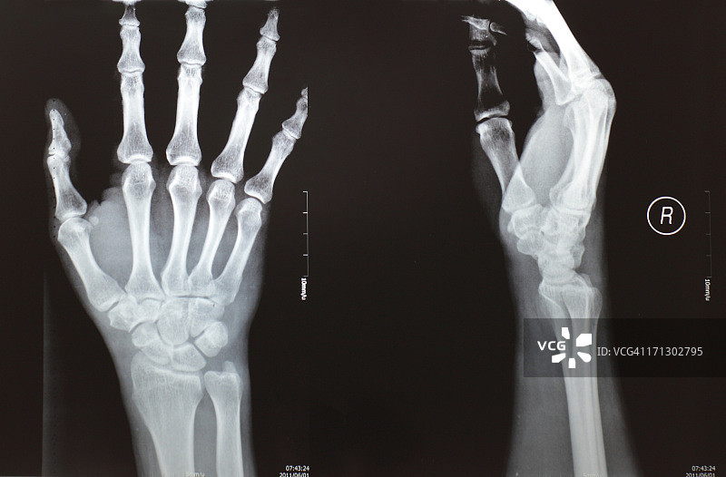 手部X光影像图片素材