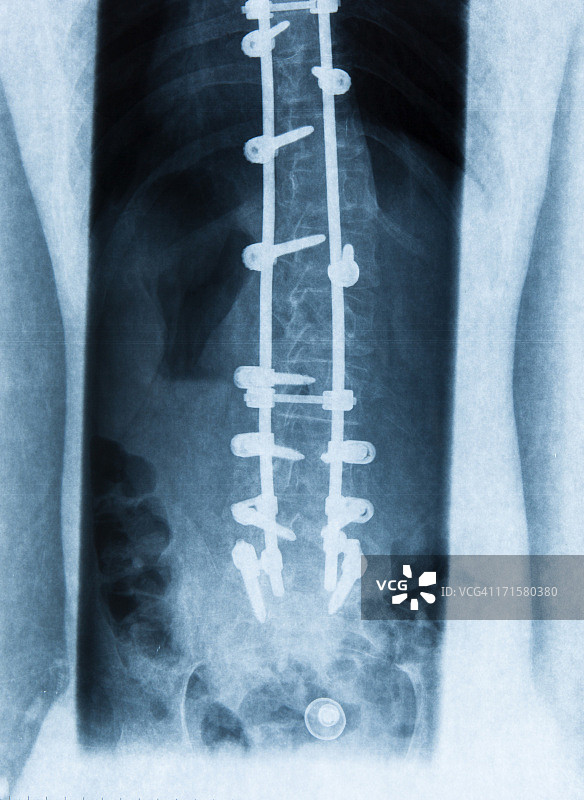 腰椎滑脱图片素材