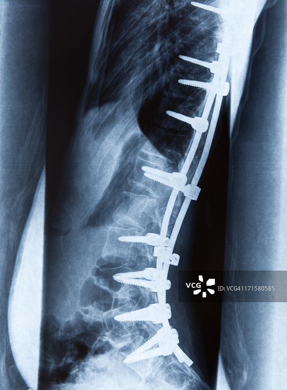 腰椎滑脱图片素材