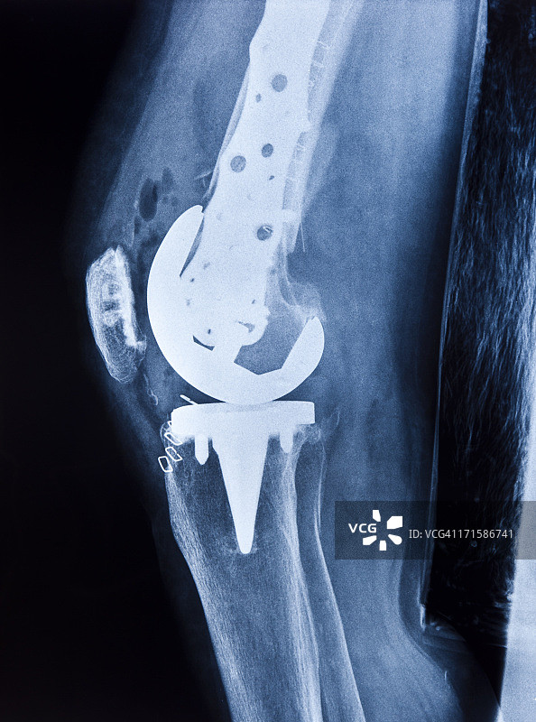 全膝关节置换图片素材