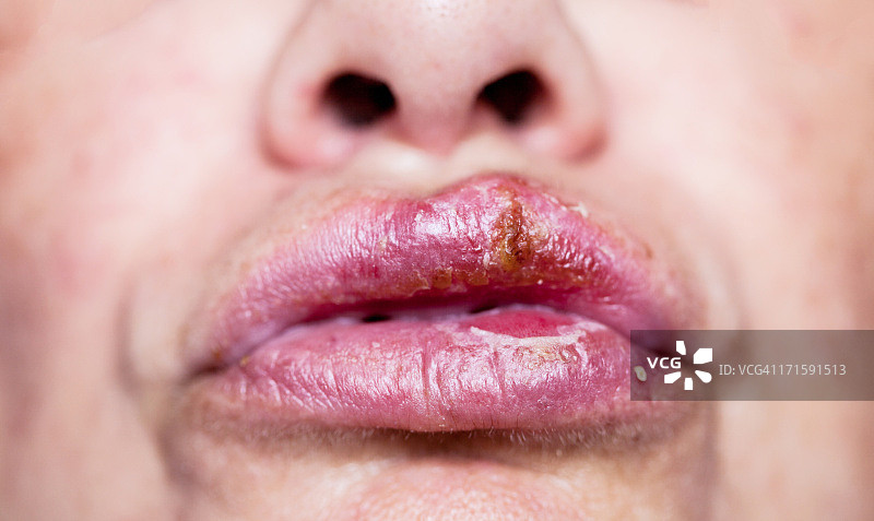 单纯疱疹口腔感染图片素材