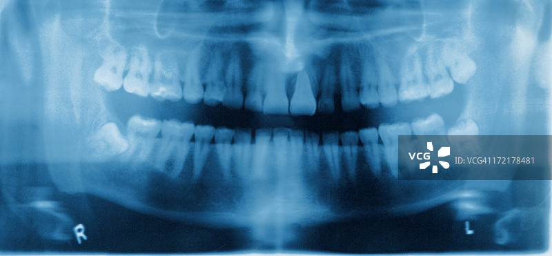蓝色和紫色的牙科X光片图片素材