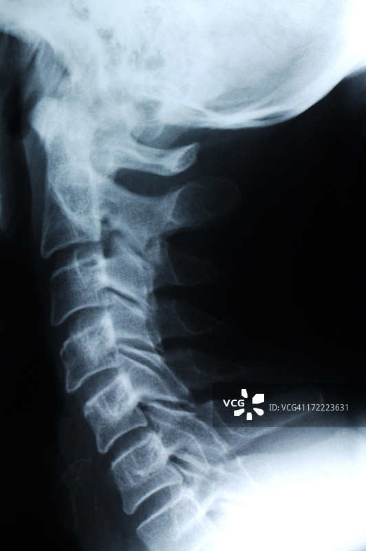 颈部X光片图片素材