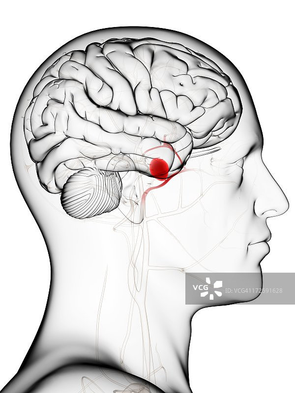 脑动脉瘤，艺术作品图片素材