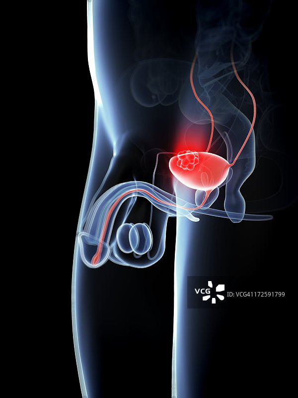 膀胱癌艺术图图片素材