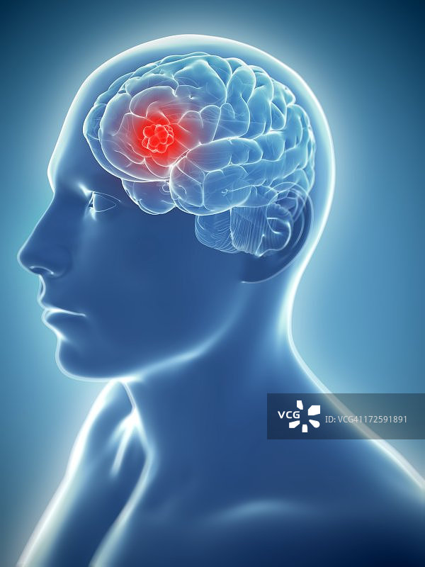 脑癌艺术作品图片素材