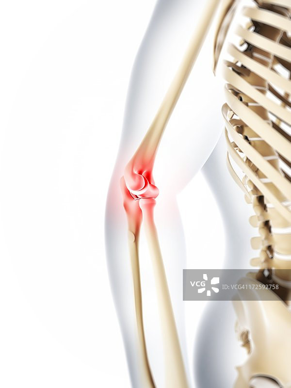 肘部疼痛概念艺术图片素材